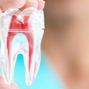 Cavities and Tooth Decay Treatment